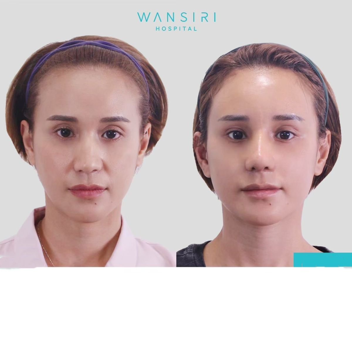 Resultados de lifting de cejas antes y después en Wansiri Hospital, elevación visible