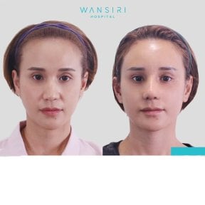 Before and after brow lift results at Wansiri Hospital, visible forehead and eyebrow lift