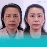 Before and after brow lift results at Wansiri Hospital, visible forehead and eye area rejuvenation