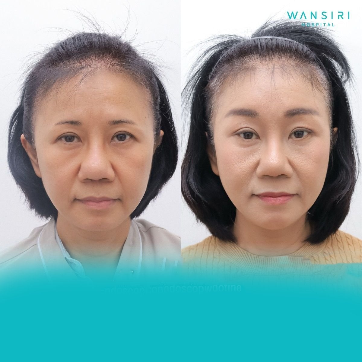 Resultados de lifting de cejas antes y después en Wansiri Hospital, rejuvenecimiento visible