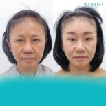 Before and after brow lift results at Wansiri Hospital, visible forehead and eye area rejuvenation
