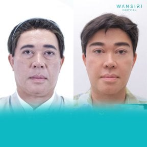 Before and after brow lift results at Wansiri Hospital, visible forehead and eye area improvement