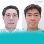 Before and after brow lift results at Wansiri Hospital, visible forehead and eye area improvement