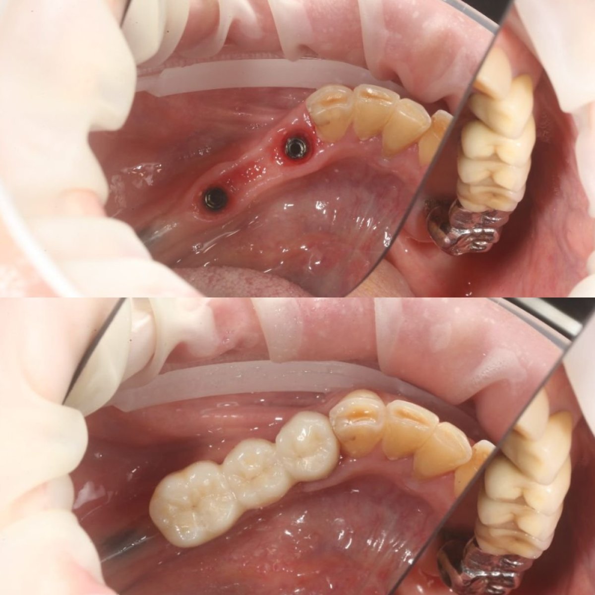 До и после имплантации Straumann в Pink Bright Studio – восстановление жевательной функции