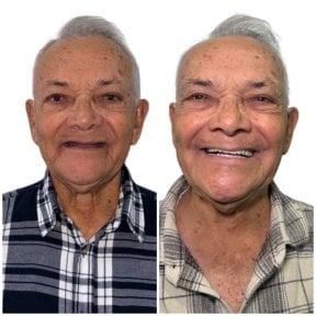 Résultat avant/après implants All-on-4 chez Varto Oral Surgery, sourire amélioré