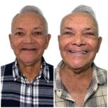 Résultat avant/après implants All-on-4 chez Varto Oral Surgery, sourire amélioré