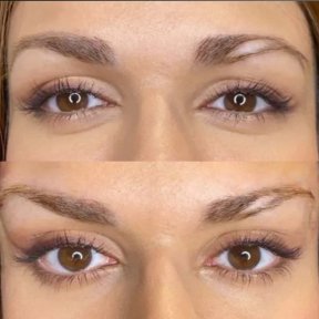 Before and after Fox Eye Lift results at ID Clinic Bangkok, lifted eyelid and brow appearance