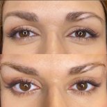 Before and after Fox Eye Lift results at ID Clinic Bangkok, lifted eyelid and brow appearance