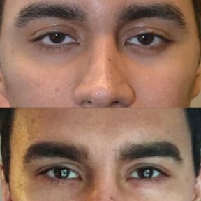Before and after Fox Eye Lift results at ID Clinic Bangkok, enhanced eye contour and lift