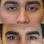 Before and after Fox Eye Lift results at ID Clinic Bangkok, enhanced eye contour and lift