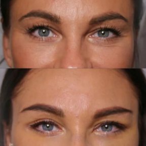 Before and after Fox Eye Lift results at ID Clinic Bangkok, lifted and elongated eye shape