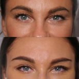 Before and after Fox Eye Lift results at ID Clinic Bangkok, lifted and elongated eye shape