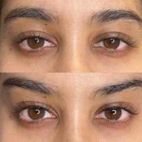 Before and after Fox Eye Lift results at ID Clinic Bangkok, lifted eyelid and eye contour