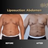 Before and after abdominal liposuction results at ID Clinic Bangkok, improved body contour