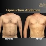 Before and after abdominal liposuction results at ID Clinic Bangkok, visible body contouring