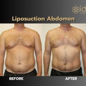 Before and after abdominal liposuction results at ID Clinic Bangkok, improved body contour