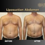 Before and after abdominal liposuction results at ID Clinic Bangkok, improved body contour
