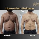 Before and after abdominal liposuction results at ID Clinic Bangkok, visible body contouring