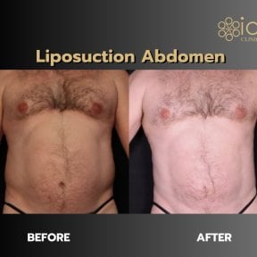 Before and after abdominal liposuction results at ID Clinic Bangkok, visible body contouring