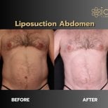 Before and after abdominal liposuction results at ID Clinic Bangkok, visible body contouring