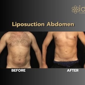 Before and after abdominal liposuction results at ID Clinic Bangkok, improved body contour