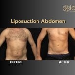Before and after abdominal liposuction results at ID Clinic Bangkok, improved body contour