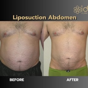 Before and after abdominal liposuction results at ID Clinic Bangkok, visible fat reduction