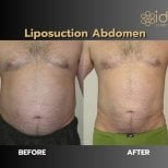 Before and after abdominal liposuction results at ID Clinic Bangkok, visible fat reduction