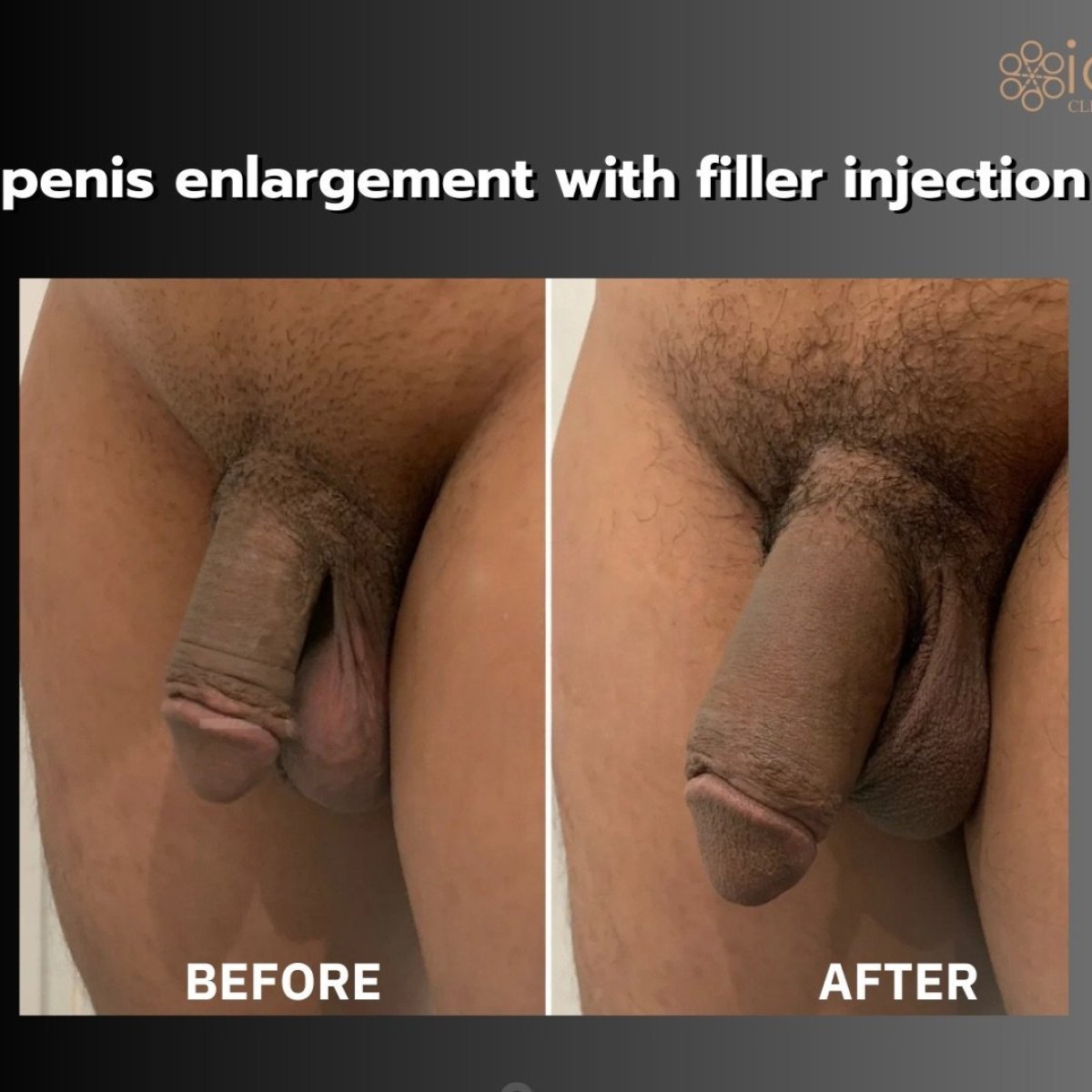 Resultados antes y después de relleno de pene en ID Clinic Bangkok – aumento visible