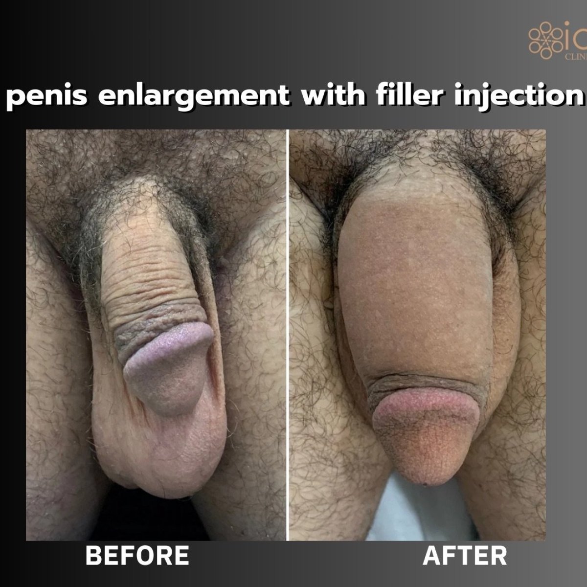 Resultados antes y después de relleno de pene en ID Clinic Bangkok – aumento visible