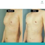 Vorher-nachher-Ergebnis der männlichen Brustverkleinerung in der Rattinan Clinic, flacher Brustkorb