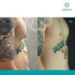 Vorher-nachher-Ergebnis der männlichen Brustverkleinerung in der Rattinan Clinic, Gynäkomastie