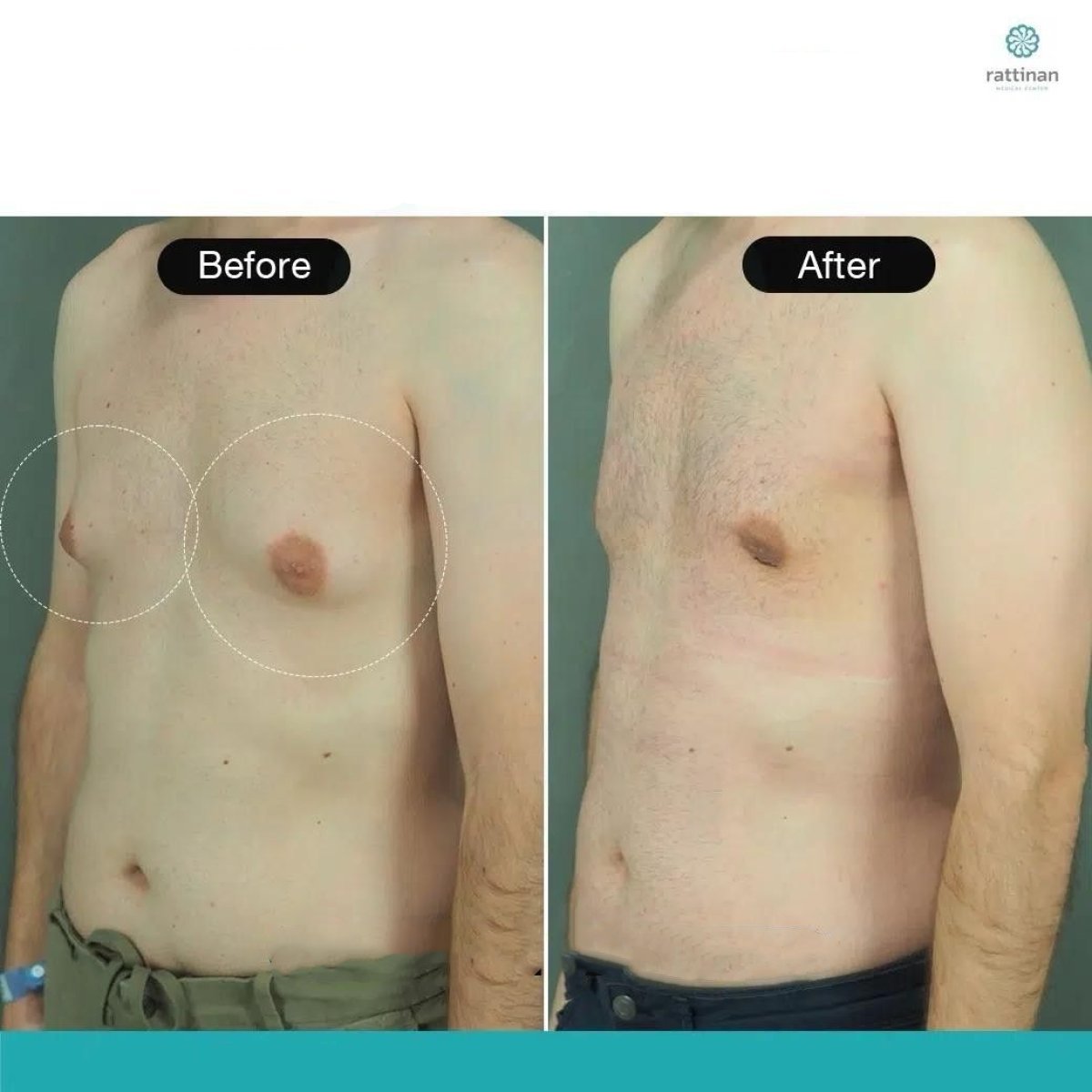 Resultados de reducción de pecho masculino antes y después en Rattinan Clinic, mejor contorno