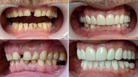 Vorher-nachher All-on-4 Zahnimplantate bei Smile Centrum, Ergebnis Komplettsanierung