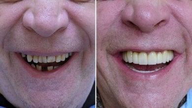 Vorher-nachher-Ergebnis All-on-4 Zahnimplantate bei Smile Centrum, vollständiges Lächeln