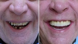 Vorher-nachher-Ergebnis All-on-4 Zahnimplantate bei Smile Centrum, vollständiges Lächeln