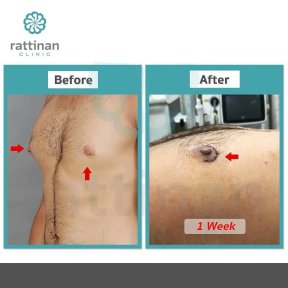 Vorher-nachher-Ergebnis der männlichen Brustverkleinerung bei Rattinan Clinic, Gynäkomastie