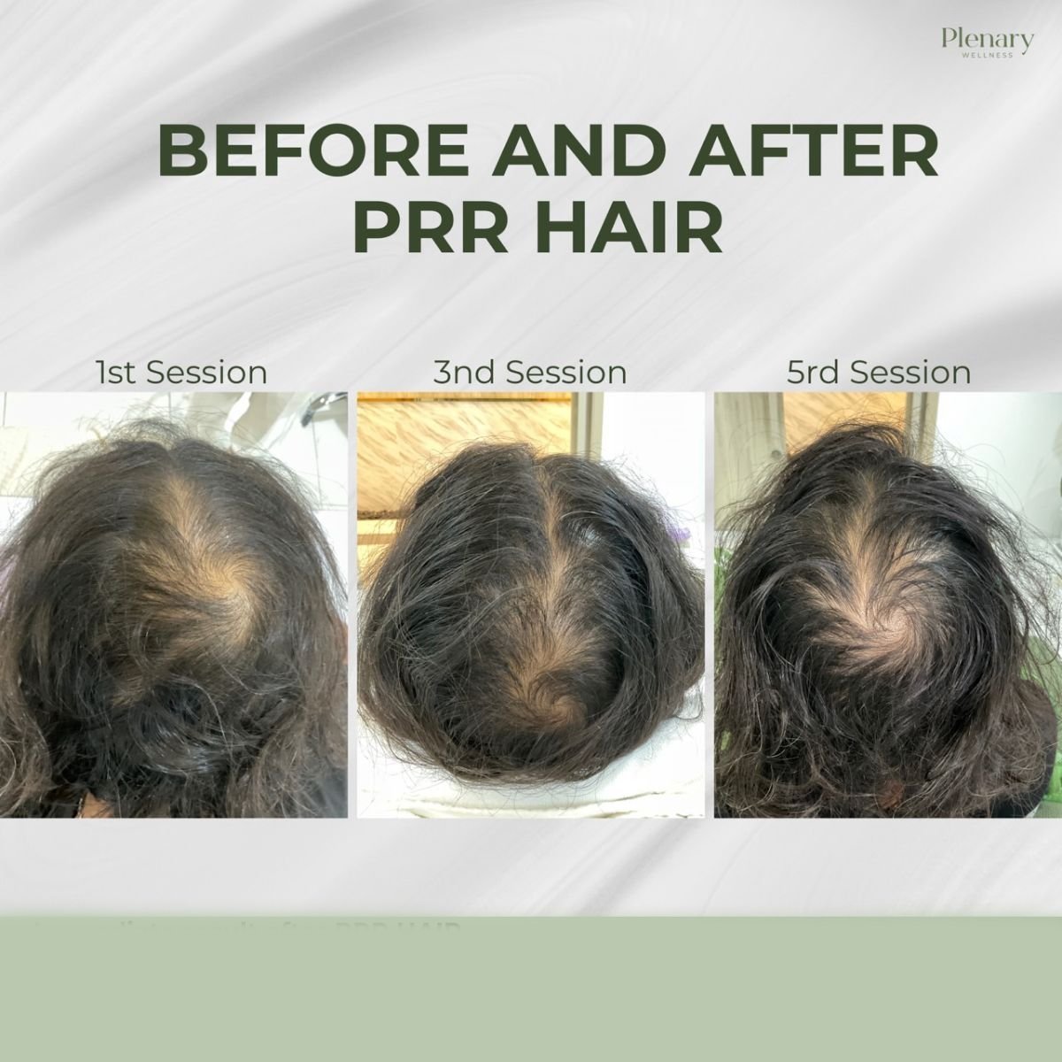 Avant/après traitement PRP contre la perte de cheveux chez Plenary Wellness – densité accrue