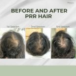 Avant/après traitement PRP contre la perte de cheveux chez Plenary Wellness – densité accrue