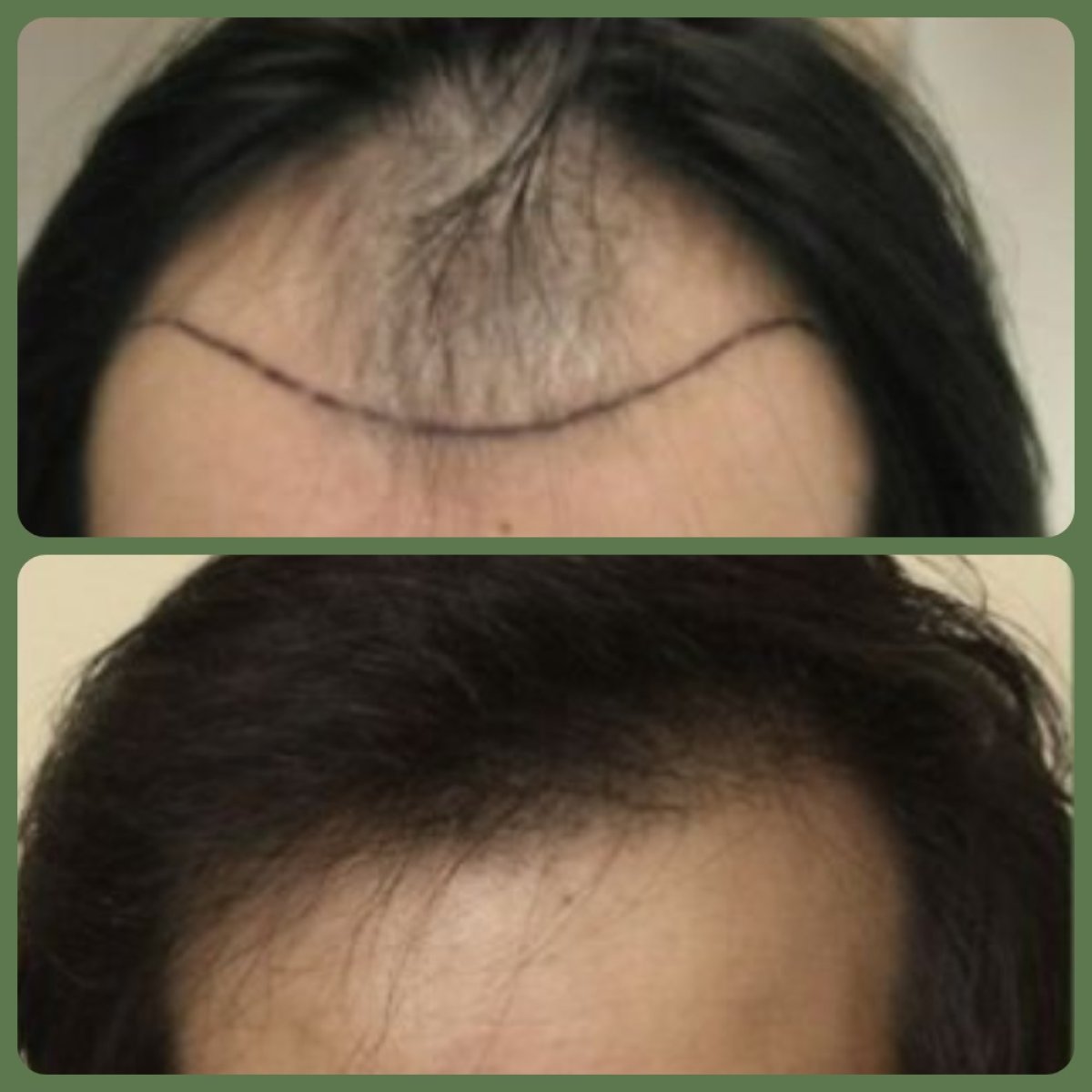 Vorher-nachher-Ergebnis Haartransplantation bei Plenary Wellness – Haaransatz wiederhergestellt