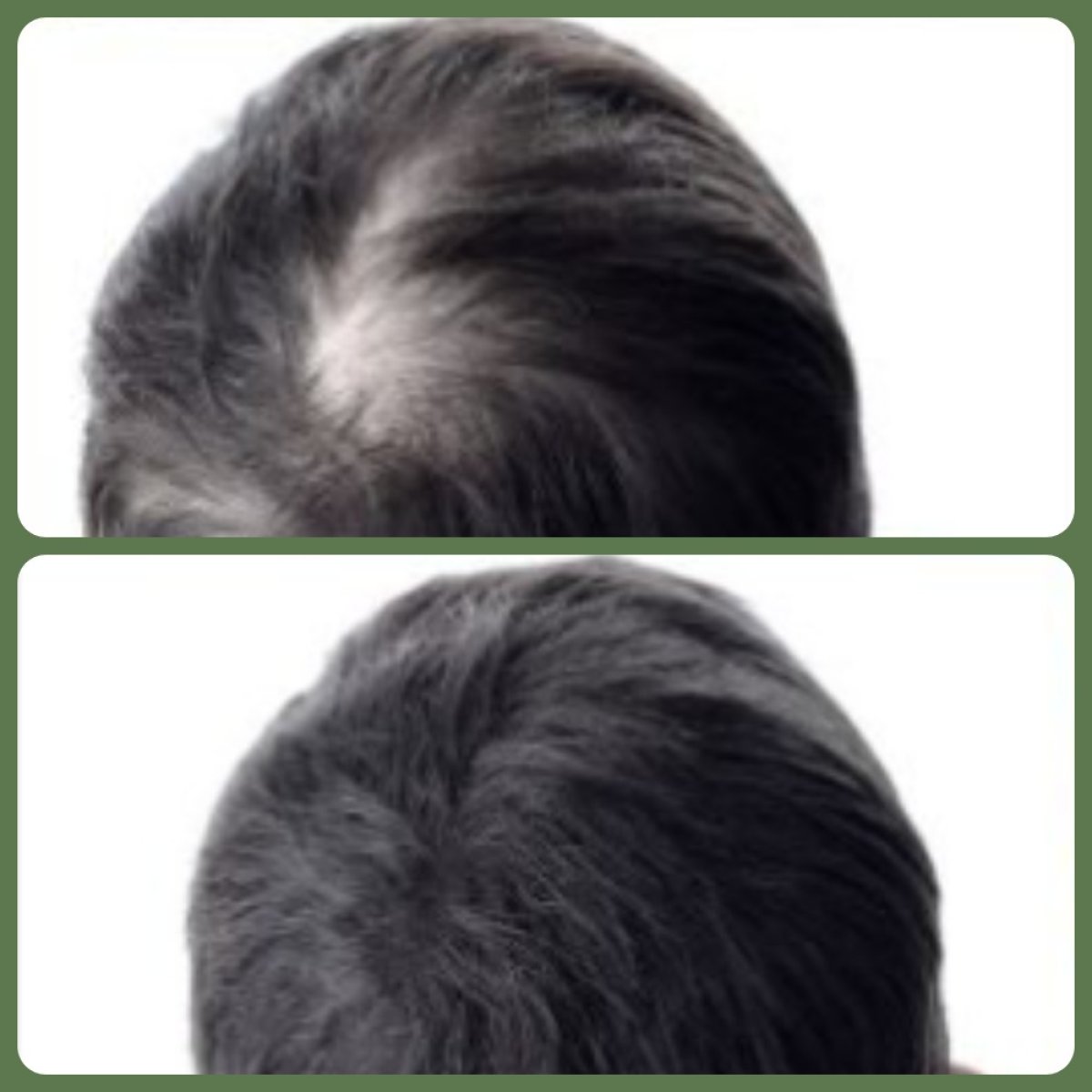 Vorher-nachher-Ergebnis Haartransplantation bei Plenary Wellness – mehr Haardichte am Oberkopf