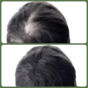 Resultados de trasplante capilar antes y después en Plenary Wellness: densidad restaurada