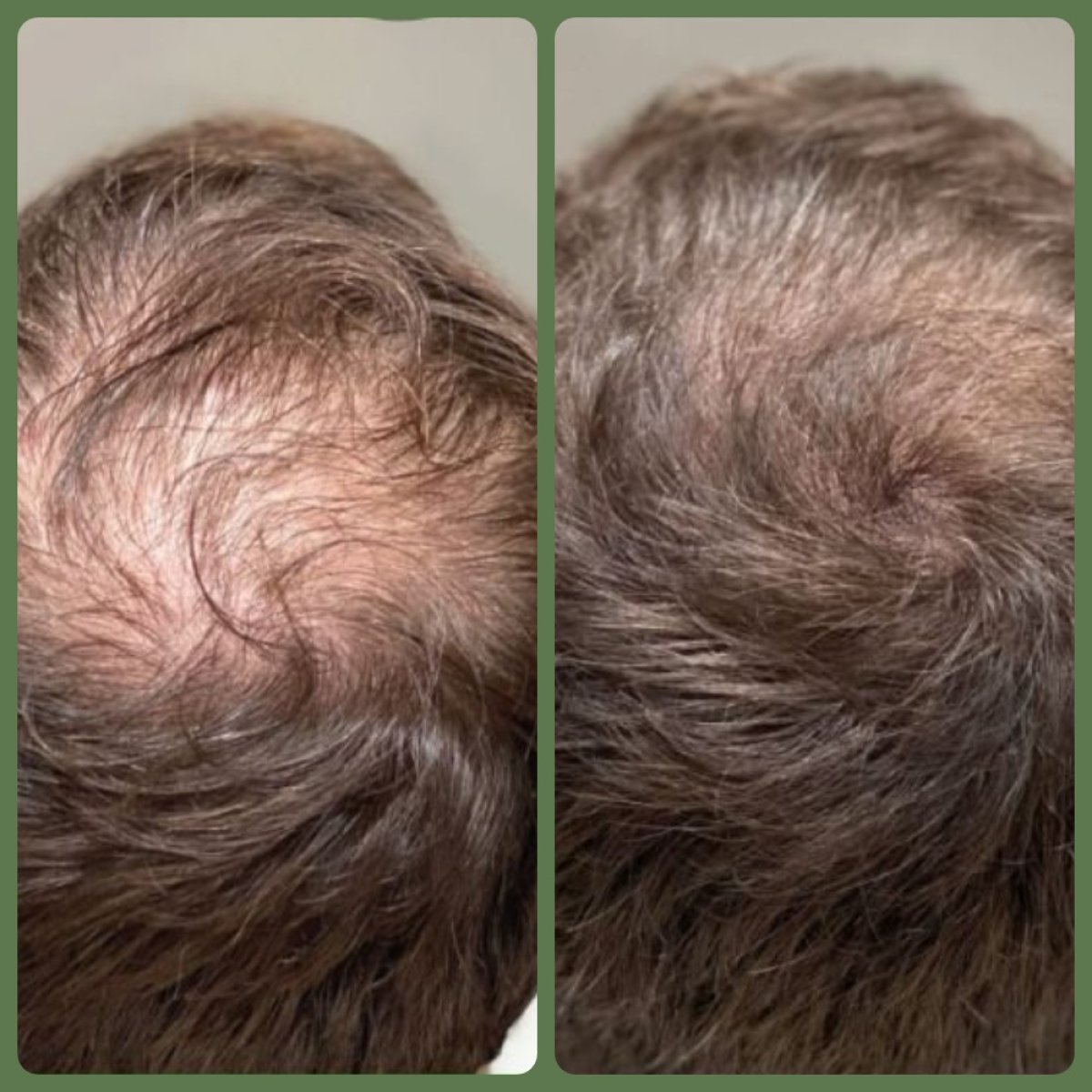 Vorher-nachher Haartransplantation bei Plenary Wellness, sichtbares Ergebnis am Hinterkopf