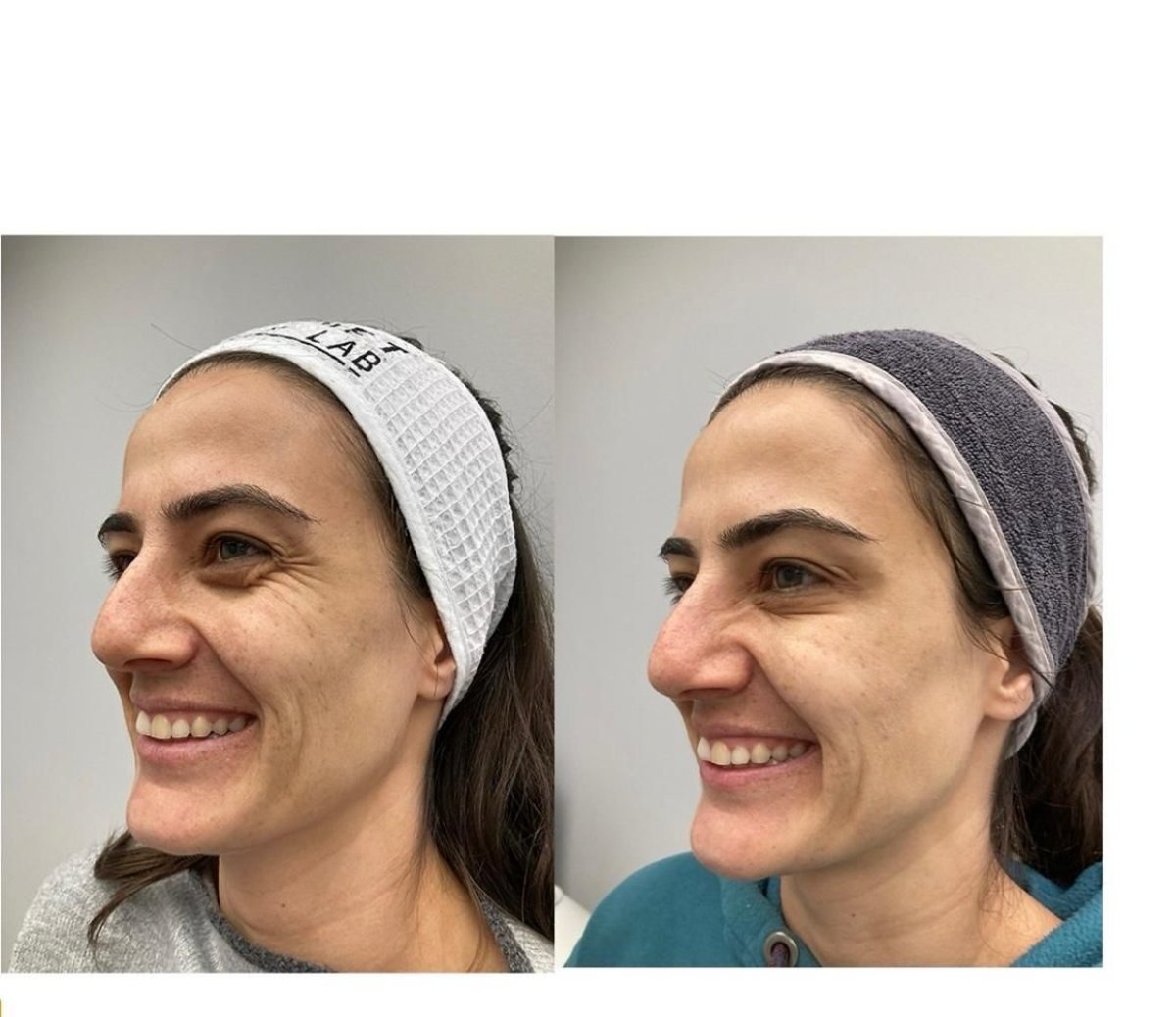 Antes y después de inyecciones de bótox en Adem and Havva Medical Center, reducción de arrugas