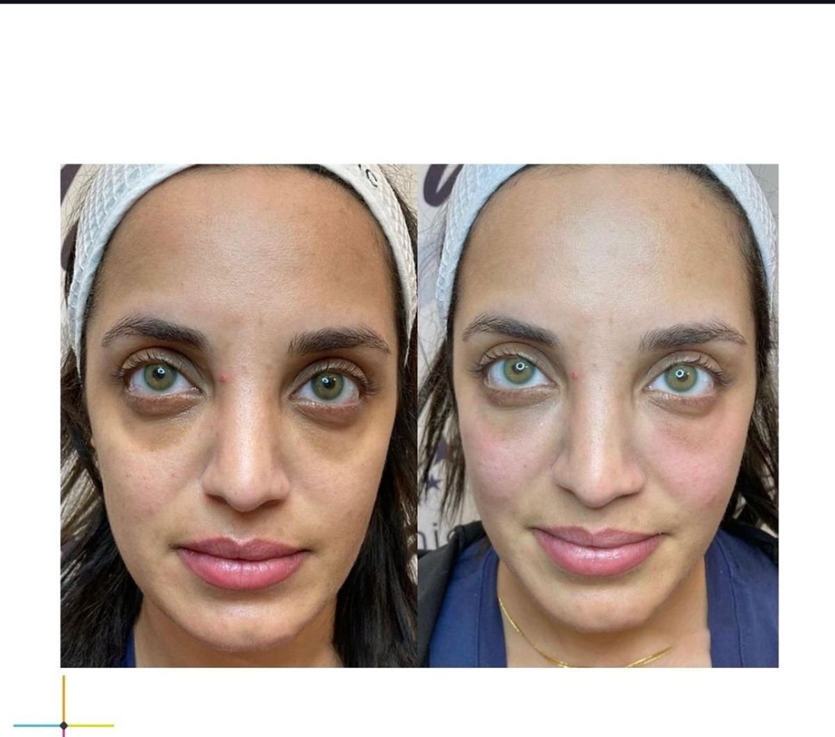 قبل وبعد حقن البوتوكس في Adem and Havva Medical Center، تقليل انتفاخ تحت العين