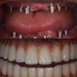 Vorher-nachher-Ergebnis All-on-6-Implantate bei DENTAGLOBAL Dental Clinic, Lächeln wiederhergestellt