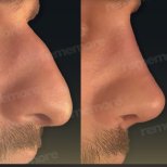 Before and after closed rhinoplasty result at Memorial Şişli Hospital, improved nose profile
