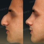 Closed rhinoplasty before and after results at Memorial Şişli Hospital, improved nose profile