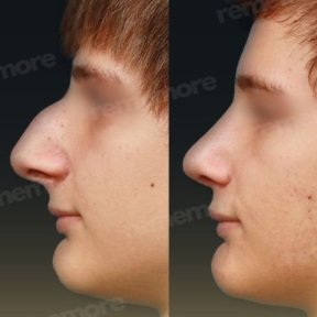 Before and after closed rhinoplasty results at Memorial Şişli Hospital, nose reshaping outcome