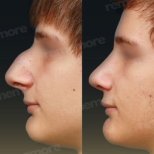 Before and after closed rhinoplasty results at Memorial Şişli Hospital, nose reshaping outcome